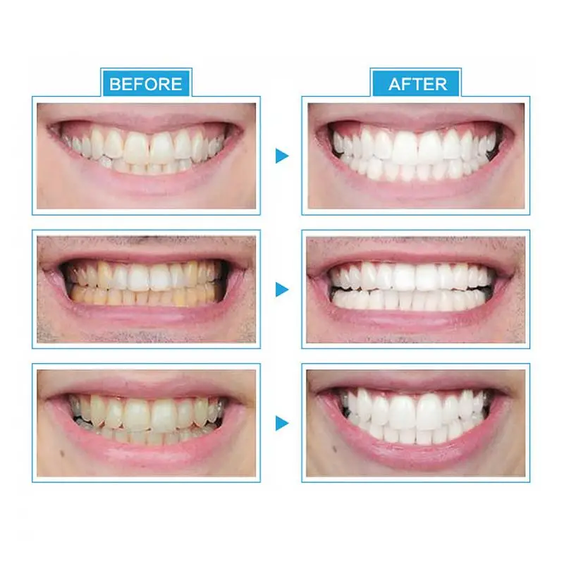 How Often Can You Whiten Your Teeth with LED Light?